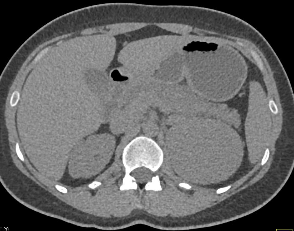 Primary Adrenal Carcinoma - CTisus CT Scan