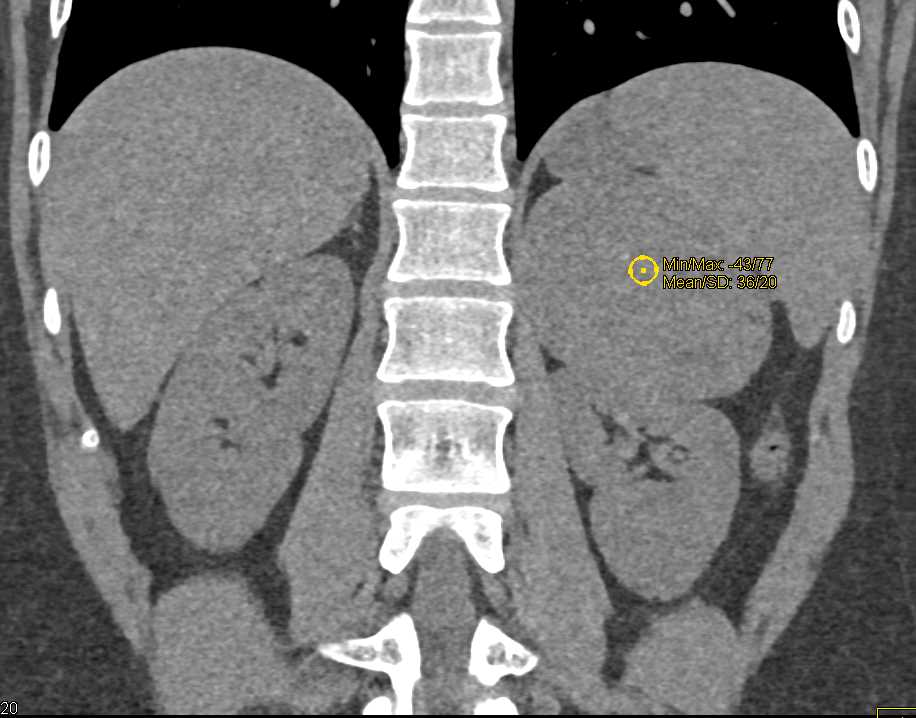 Primary Adrenal Carcinoma - CTisus CT Scan