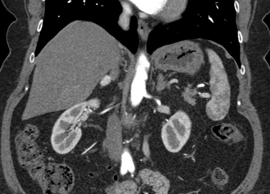 Incidental Pheochromocytoma Right Adrenal Gland - CTisus CT Scan