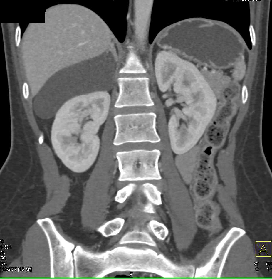 cyst on adrenal gland on kidney
