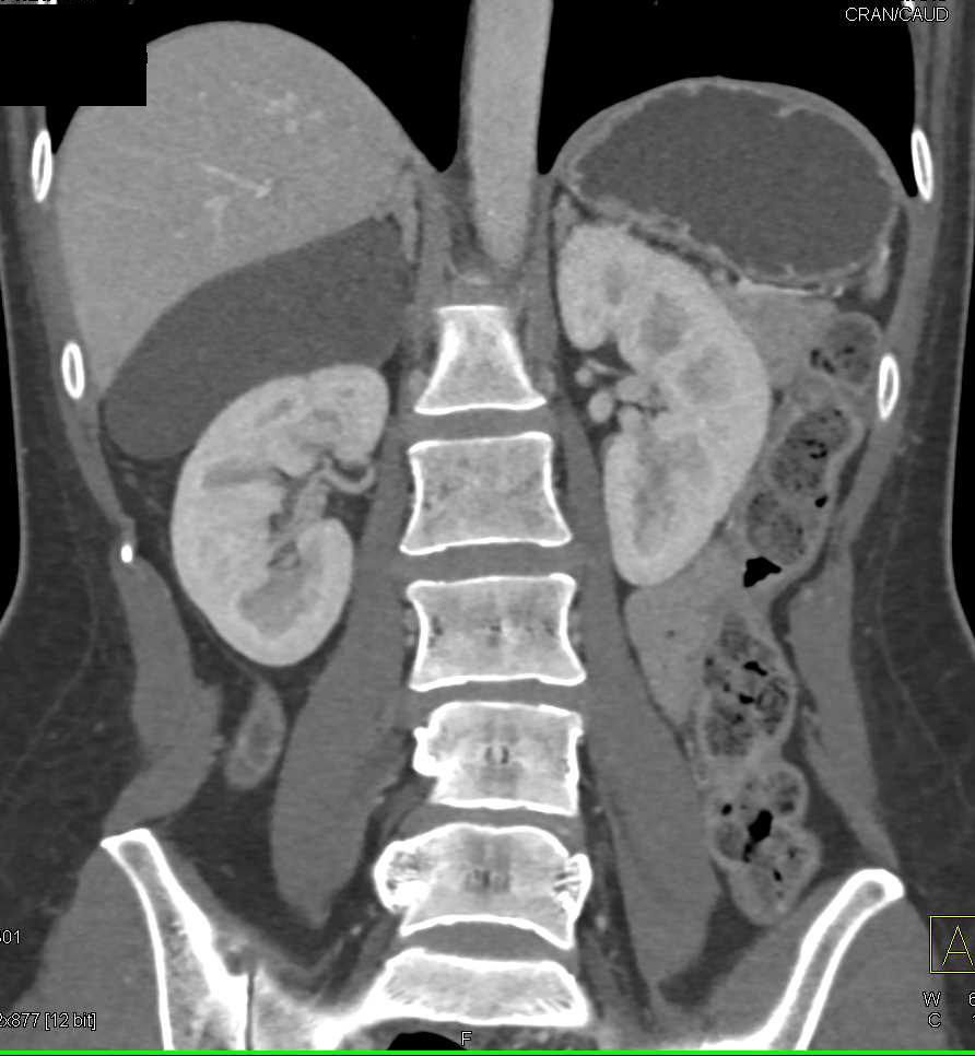 Right Adrenal Cyst - CTisus CT Scan