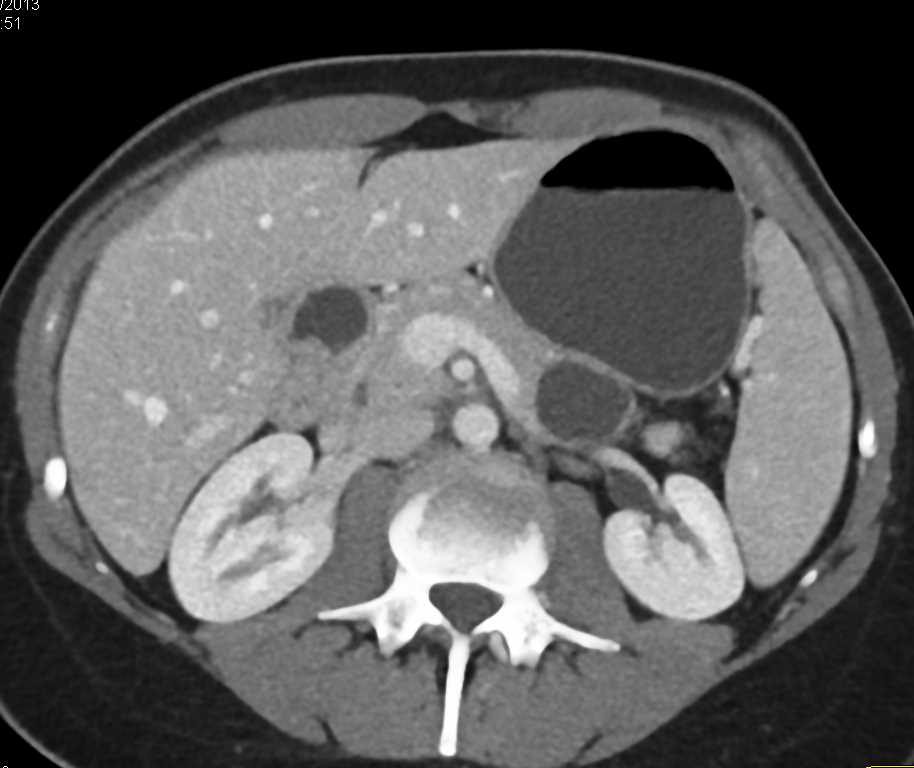 MCN (Mucinous Cystic Neoplasm) Pancreatic Tail - CTisus CT Scan