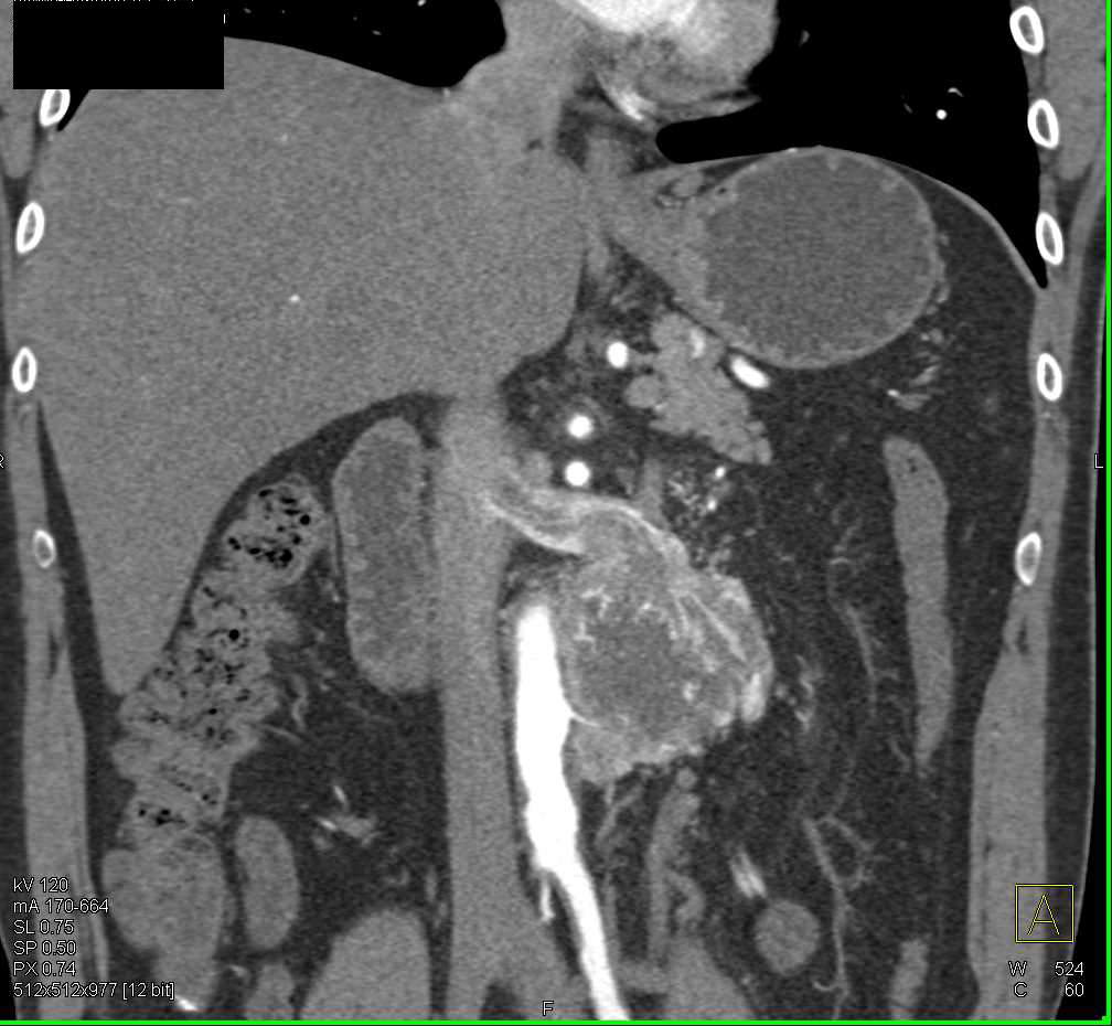 Paraganglioma Invades the Left Renal Vein - CTisus CT Scan