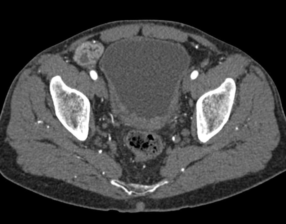 Bladder Cancer with Adenopathy - CTisus CT Scan