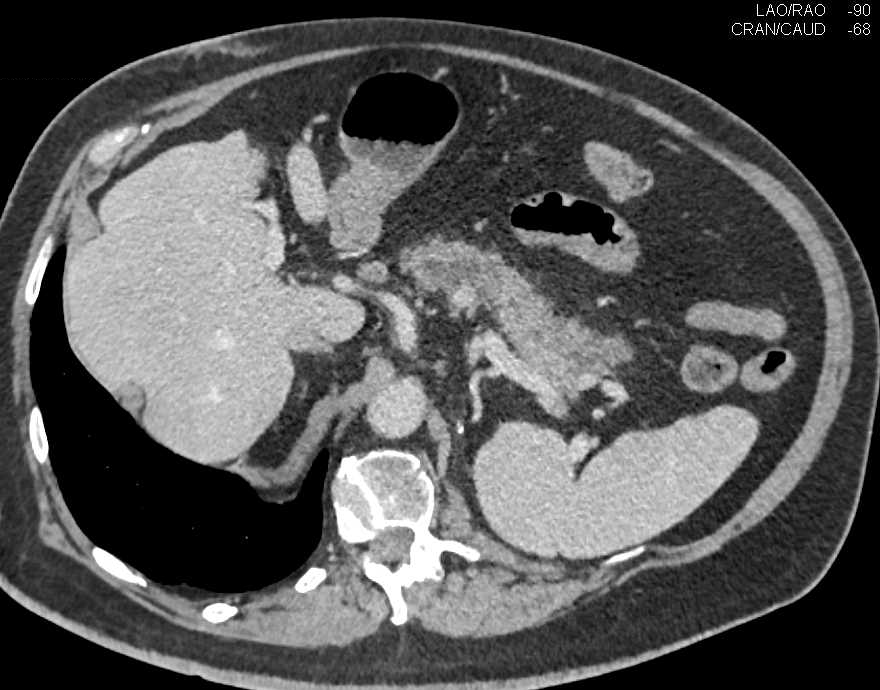 Metastatic Renal Cell Carcinoma to Right Adrenal Gland and the Pancreas - CTisus CT Scan