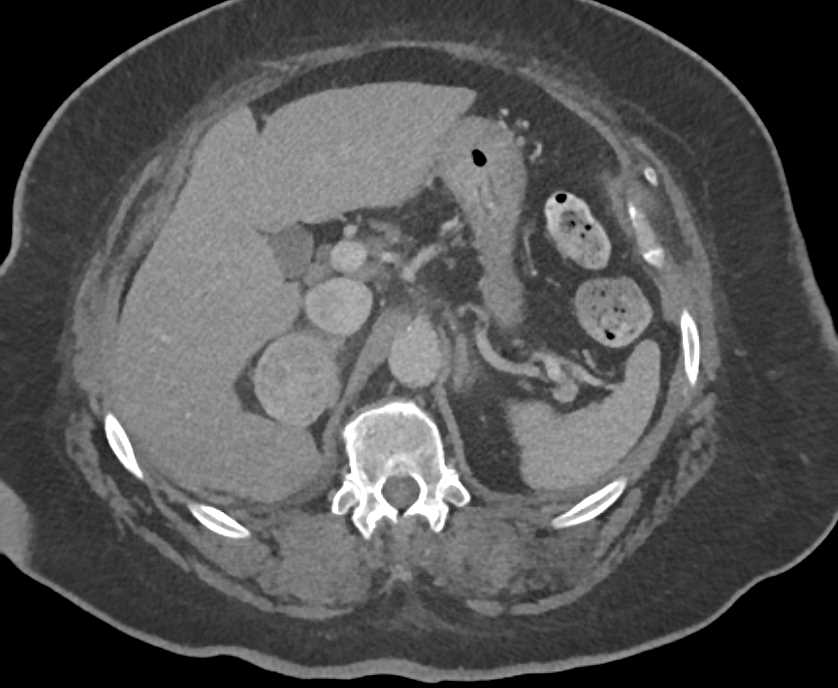 Right Adrenal Pheochromocytoma - CTisus CT Scan