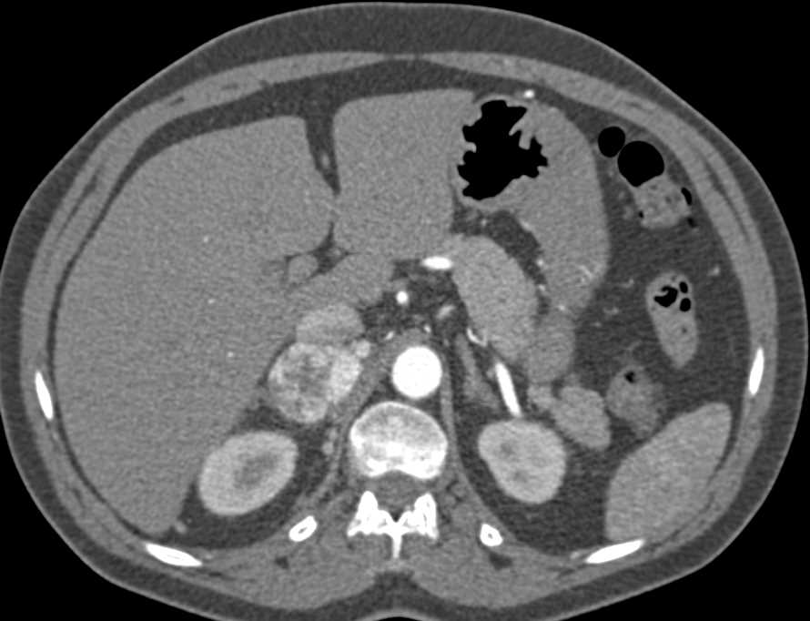 Pheochromocytoma Right Adrenal Gland - CTisus CT Scan