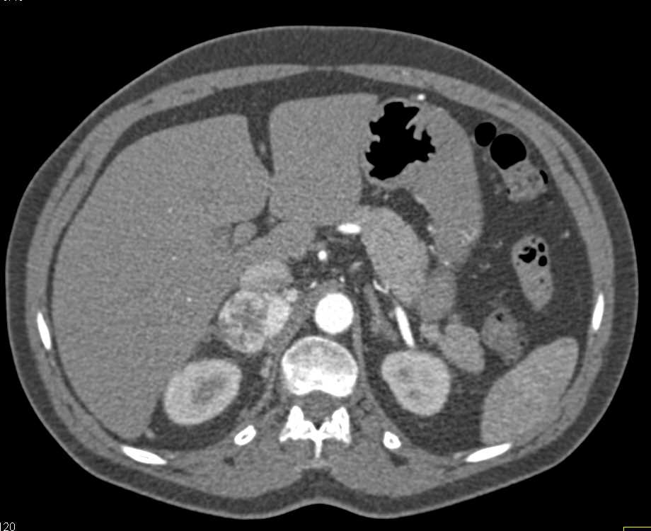 Pheochromocytoma Right Adrenal Gland - CTisus CT Scan