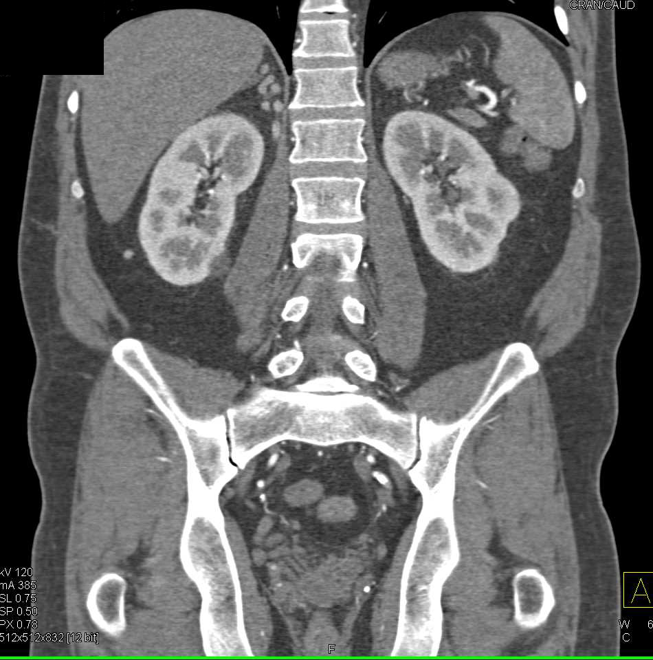 Pheochromocytoma Right Adrenal Gland - CTisus CT Scan