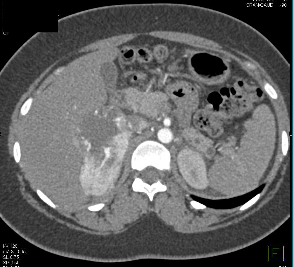 Primary Adrenal Carcinoma - CTisus CT Scan