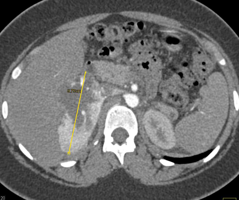 Primary Adrenal Carcinoma - CTisus CT Scan