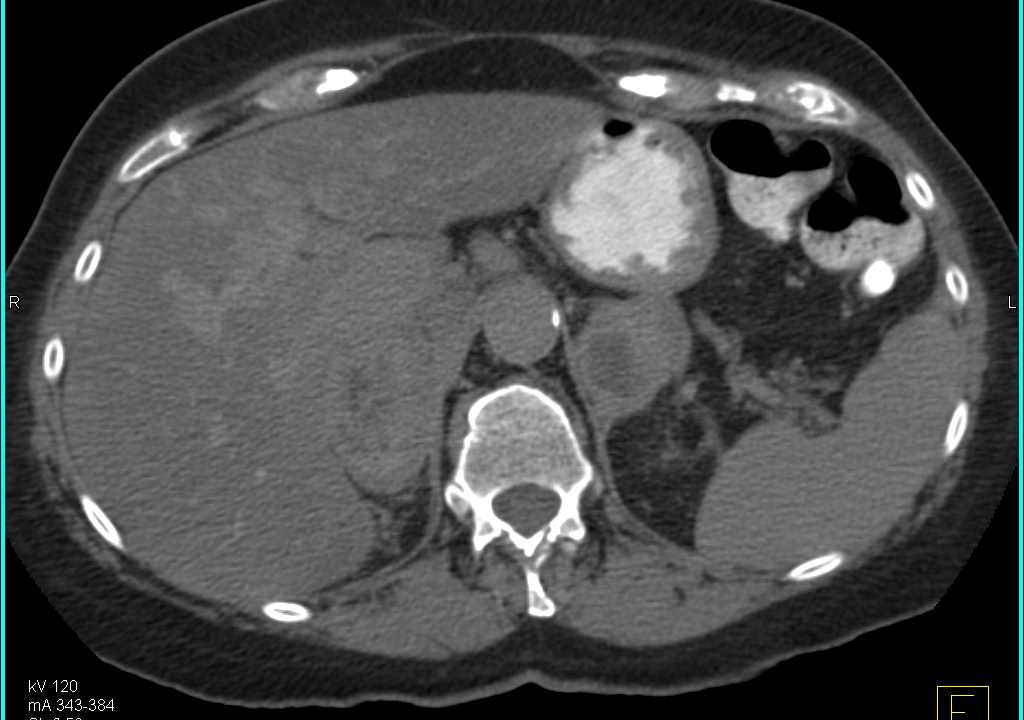 Bilateral Adrenal Metastases from Melanoma - CTisus CT Scan