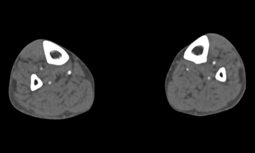 CTA Runoff with Peripheral Vascular Disease - CTisus CT Scan