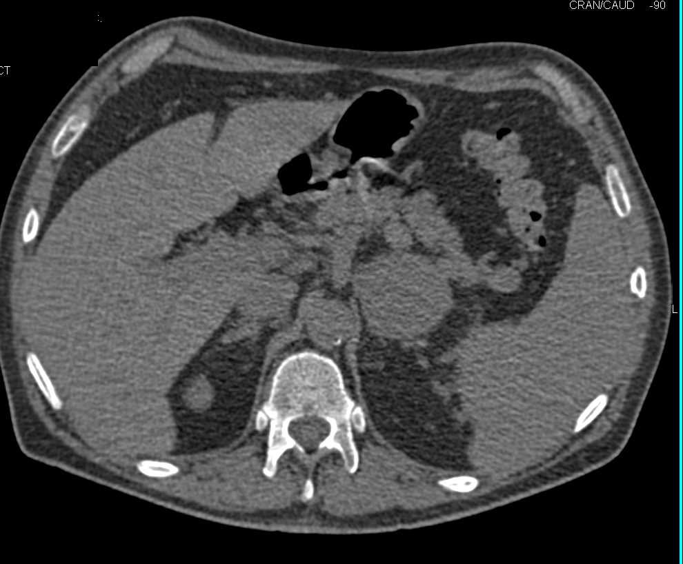 Left Renal Cell Carcinoma with Adrenal Metastases - CTisus CT Scan