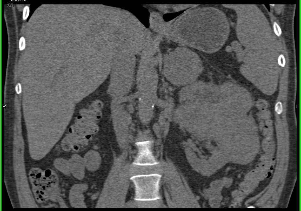 Left Renal Cell Carcinoma with Adrenal Metastases - CTisus CT Scan