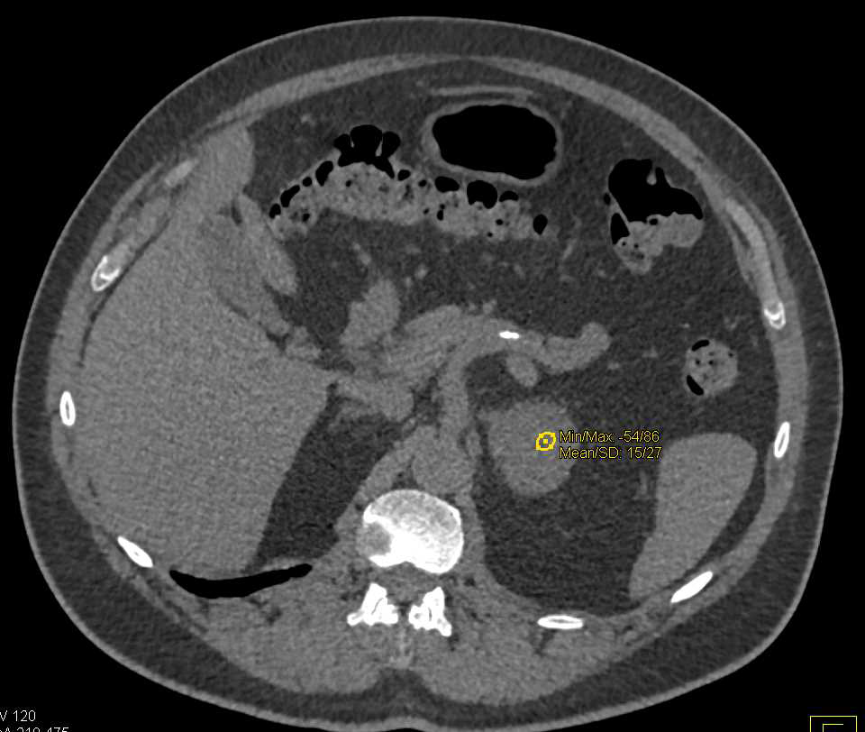 Functioning Adrenal Adenoma - CTisus CT Scan