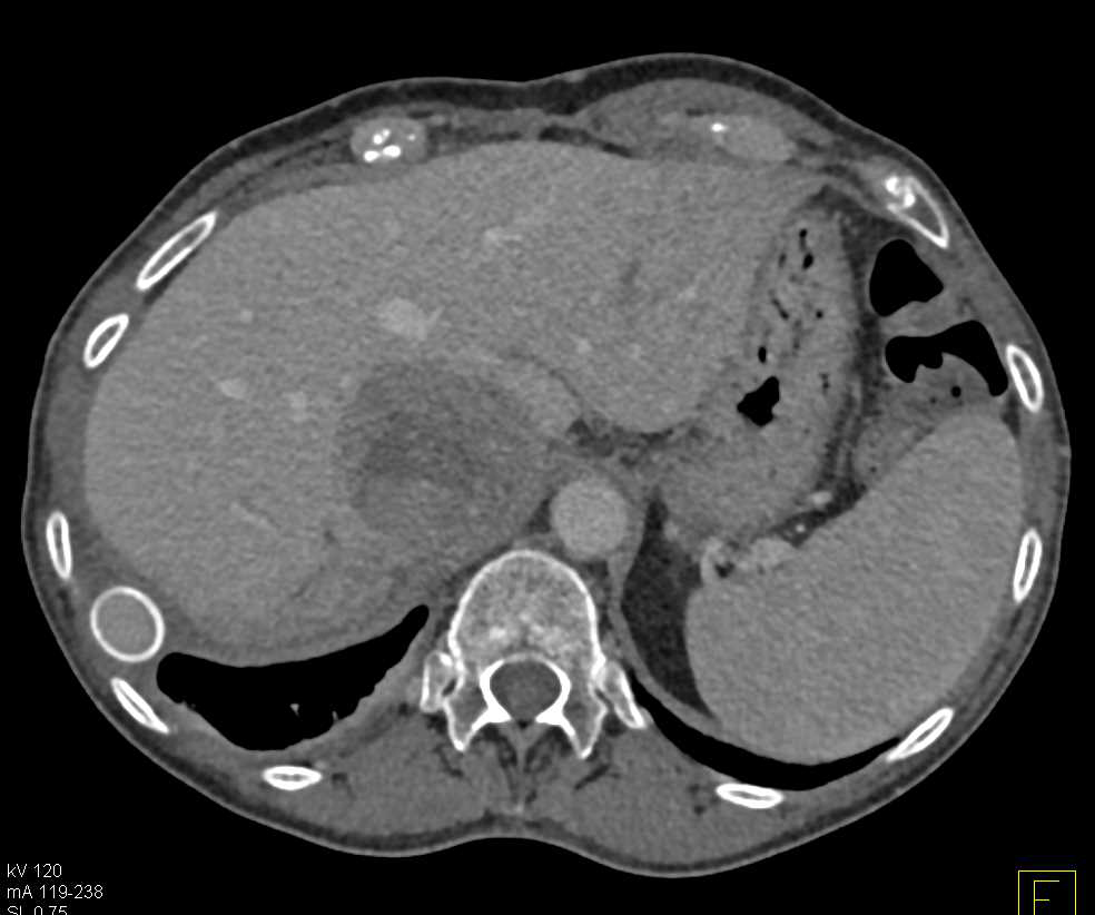 Inferior Vena Cava (IVC) Bypass Graft with Adrenal Carcinoma - CTisus CT Scan