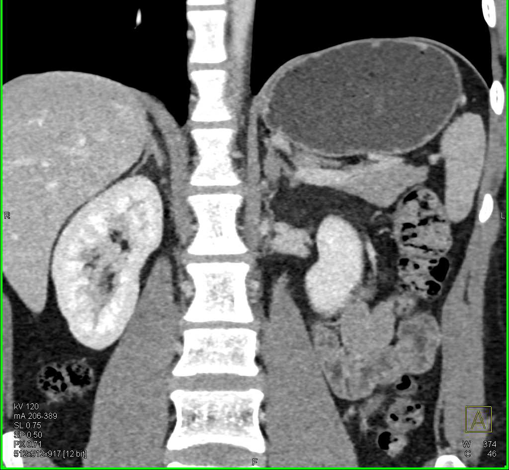 Adenoma Left Adrenal Gland - CTisus CT Scan