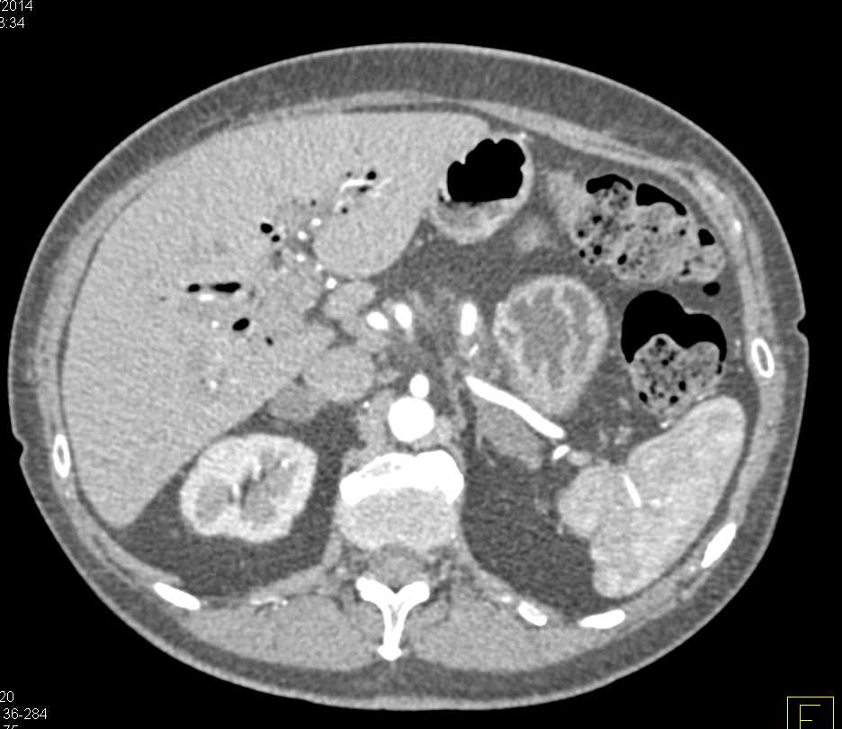 Bilateral Adrenal Adenomas - CTisus CT Scan