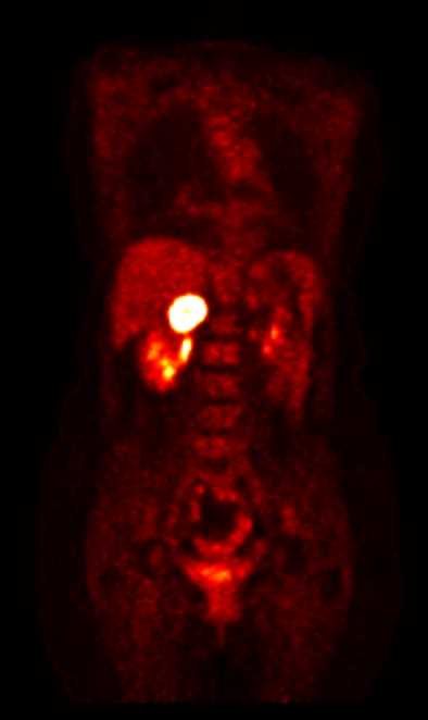 Metastases to the Left Adrenal Gland from Lung Cancer - CTisus CT Scan