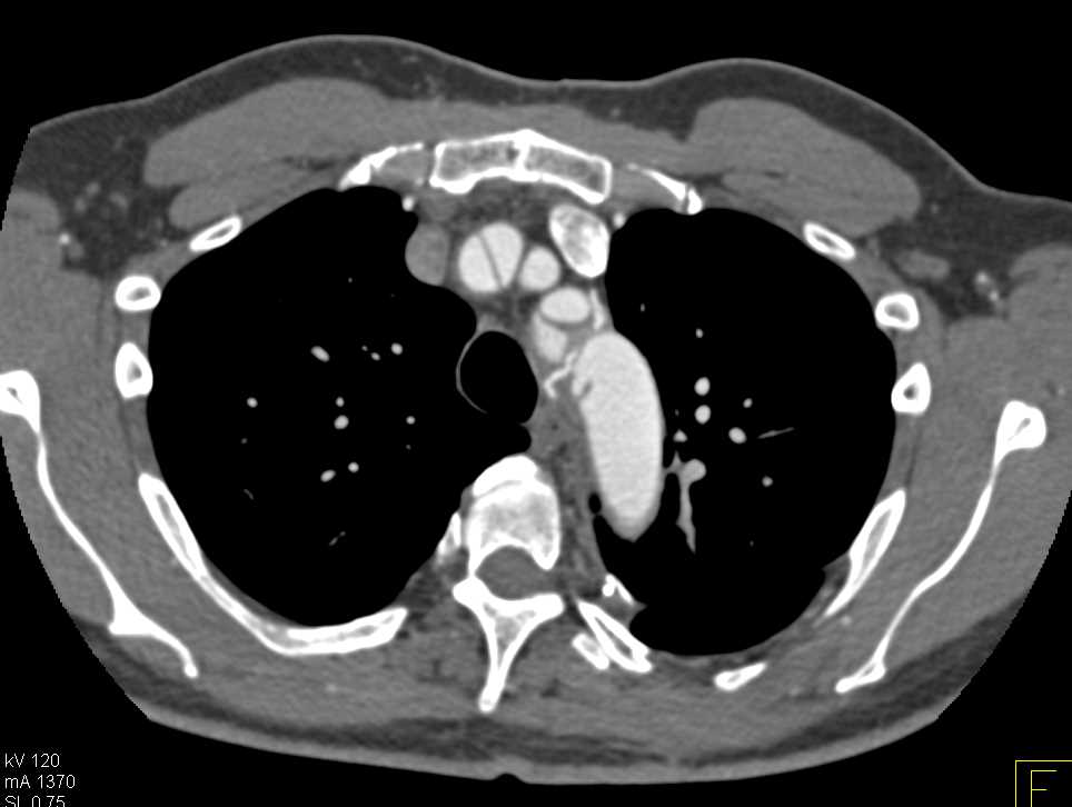 Type A Dissection Extending into the Right Subclavian Artery - CTisus CT Scan