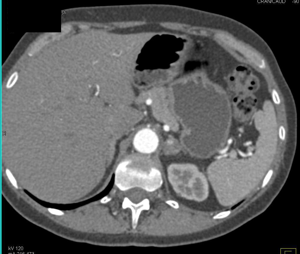 Incidental Enhancing Left Adrenal Adenoma - CTisus CT Scan