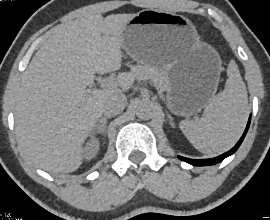 Right Adrenal Adenoma - CTisus CT Scan