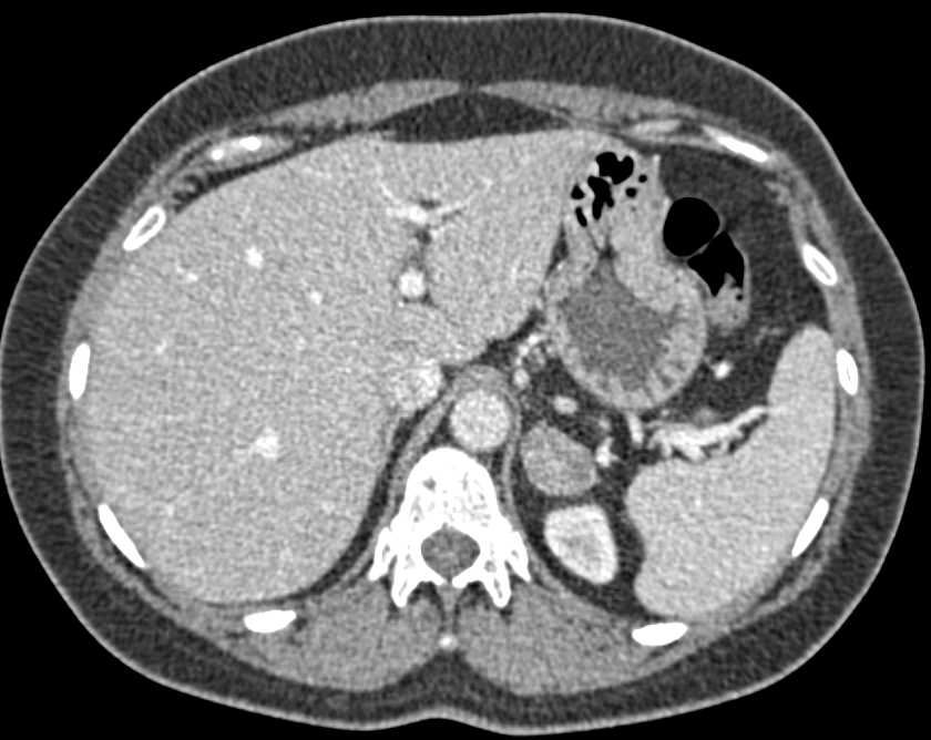 Left Adrenal Adenoma - CTisus CT Scan