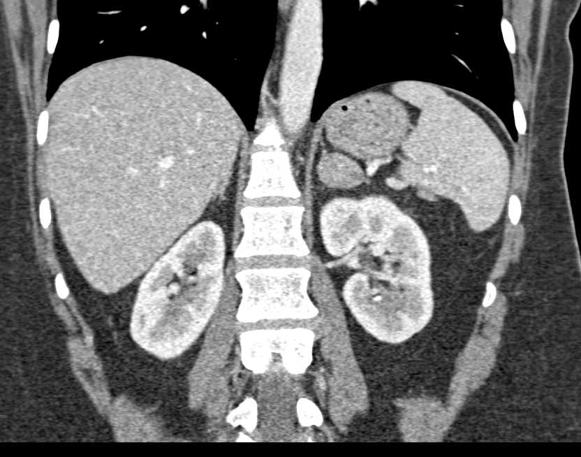 Left Adrenal Adenoma - Adrenal Case Studies - CTisus CT Scanning