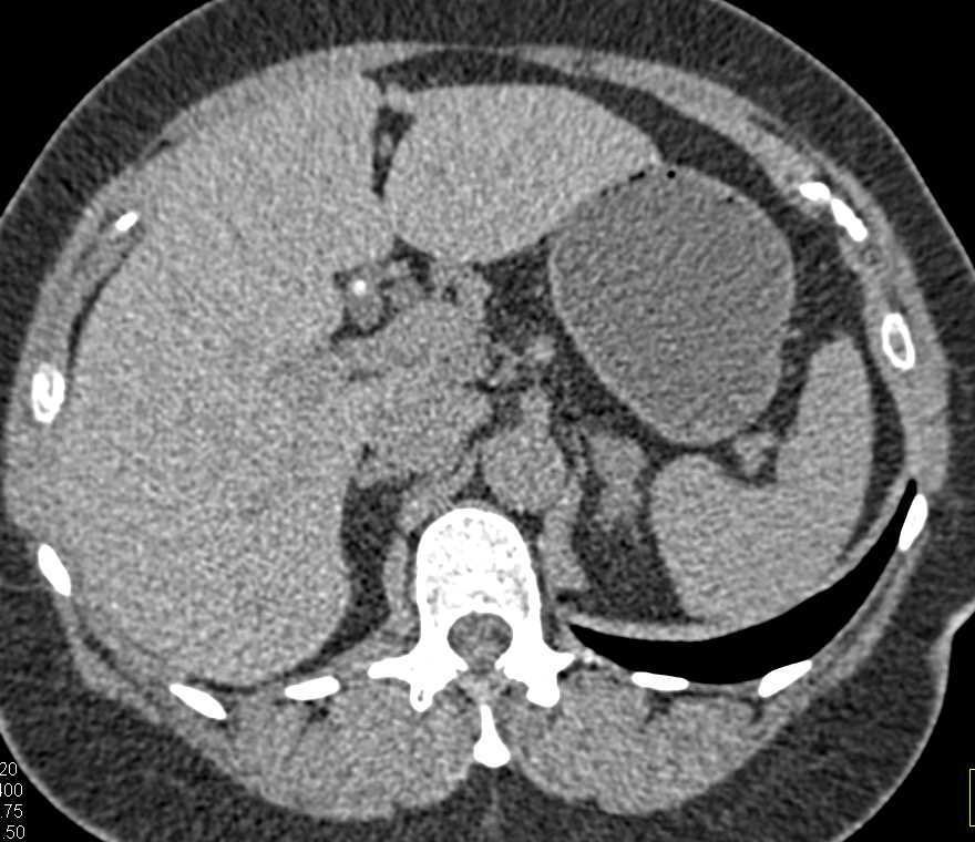 1cm Pheochromocytoma Left Adrenal Gland - CTisus CT Scan