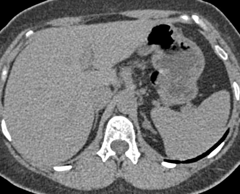 Left Adrenal Adenoma - CTisus CT Scan