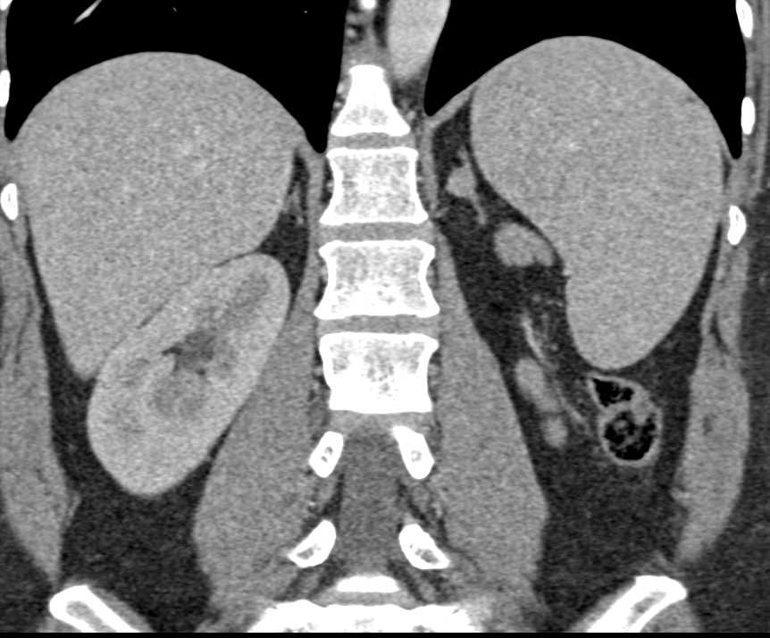 Left Adrenal Adenoma - Adrenal Case Studies - CTisus CT Scanning