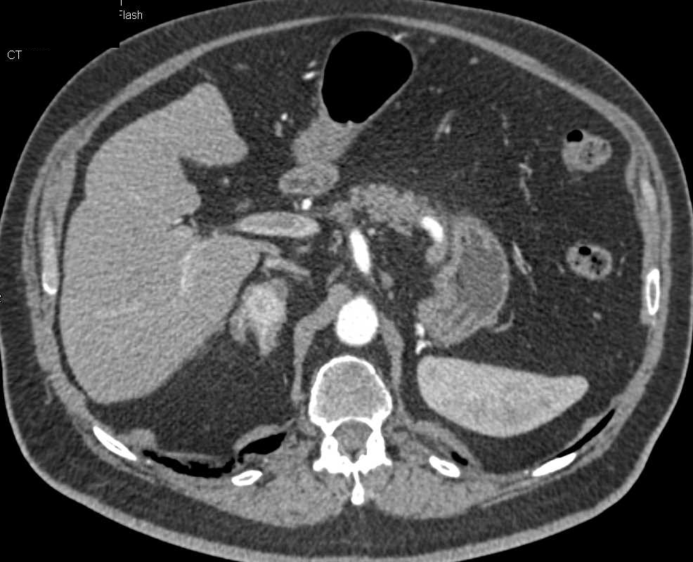 Recurrent Renal Cell Carcinoma with Enhancing Right Adrenal Metastases - CTisus CT Scan