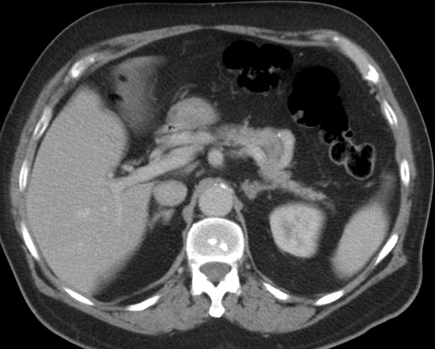 Bilateral Small Adrenal Adenomas - CTisus CT Scan