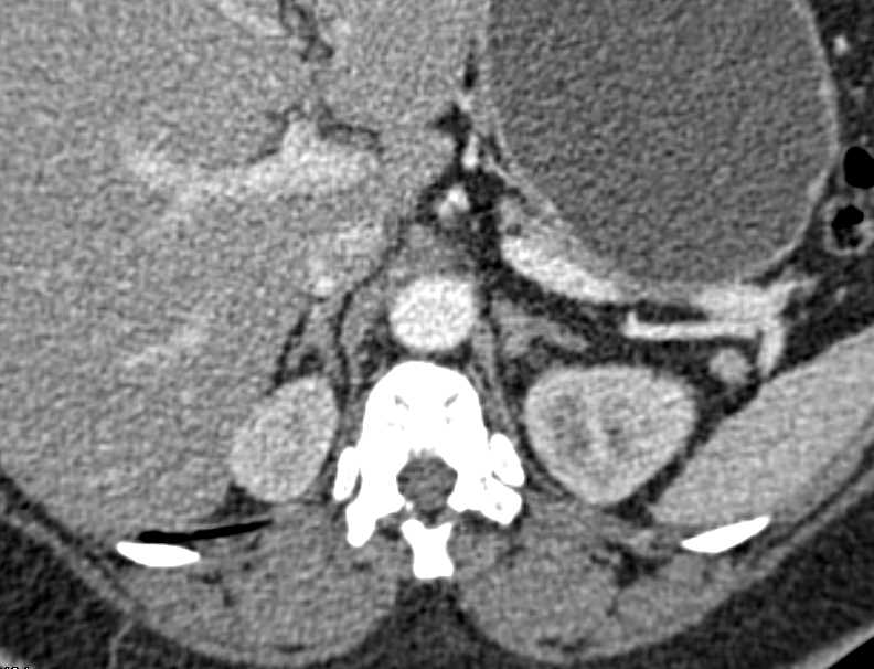 Normal Adrenal Glands in Patient with Suspected Aldosteronoma - CTisus CT Scan