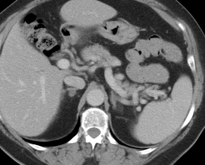 Bilateral Adrenal Adenomas - CTisus CT Scan