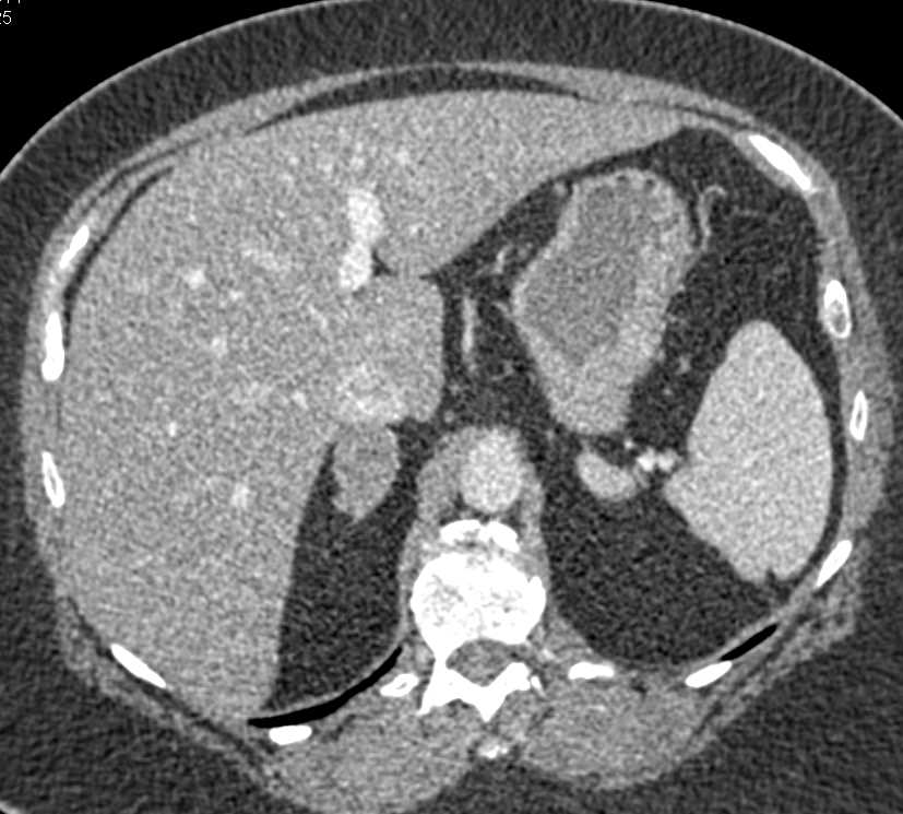 Right Adrenal Adenoma - CTisus CT Scan