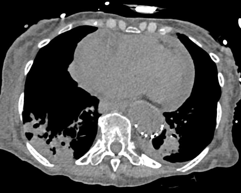 Type A Dissection with Mediastinal Bleed - CTisus CT Scan