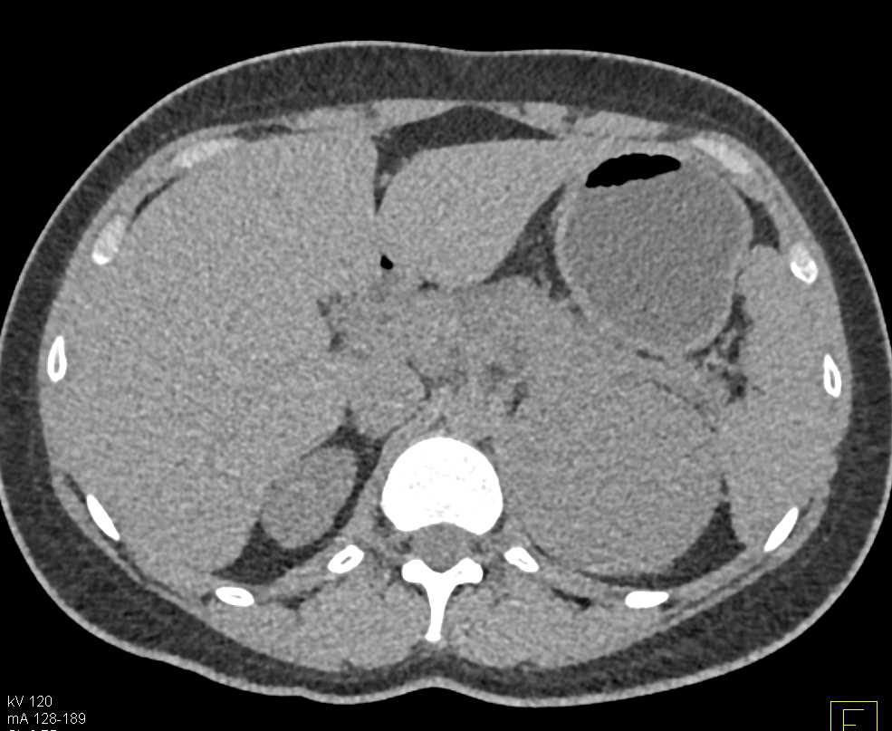 Primary Left Adrenal Carcinoma - CTisus CT Scan