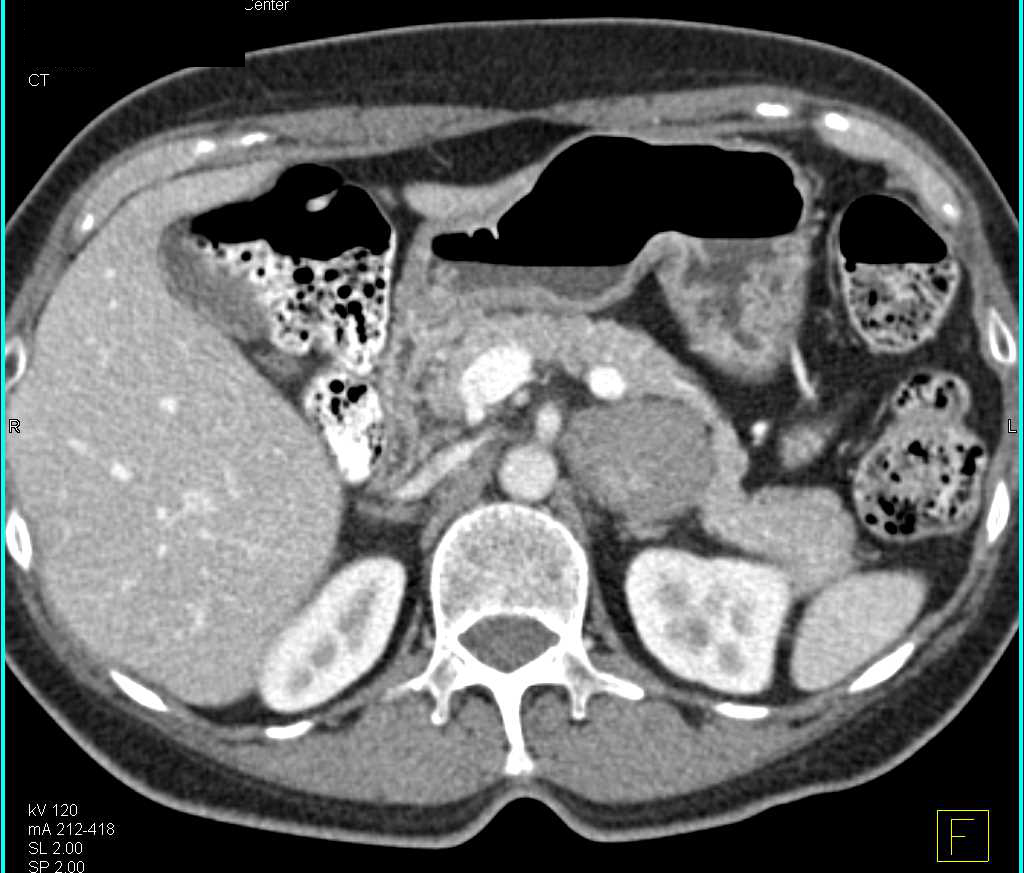 Atypical Pheochromocytoma Left Adrenal Gland - Adrenal Case Studies ...