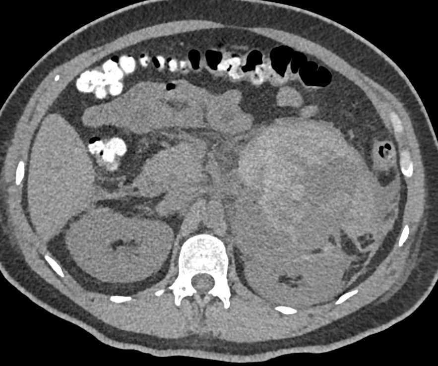 Large Left Upper Quadrant Bleed due to Underlying Tumor in Adrenal Gland - CTisus CT Scan