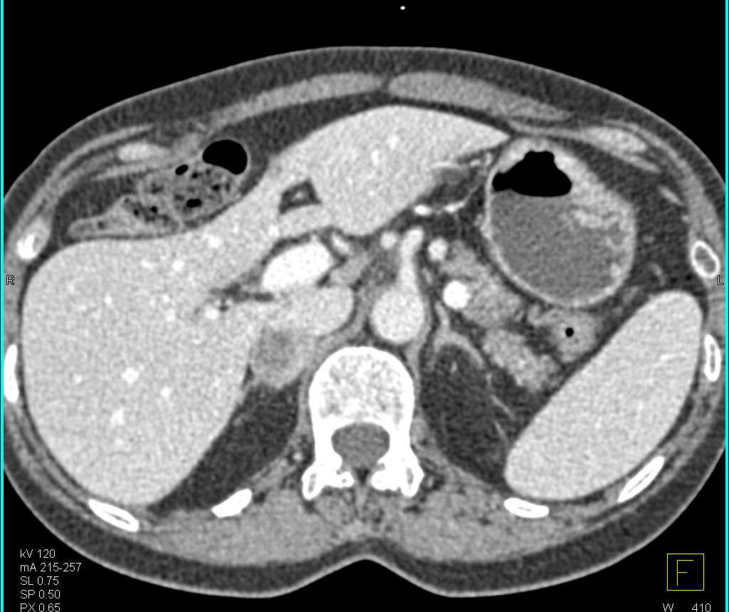 Metastases to the Right Adrenal Gland - CTisus CT Scan