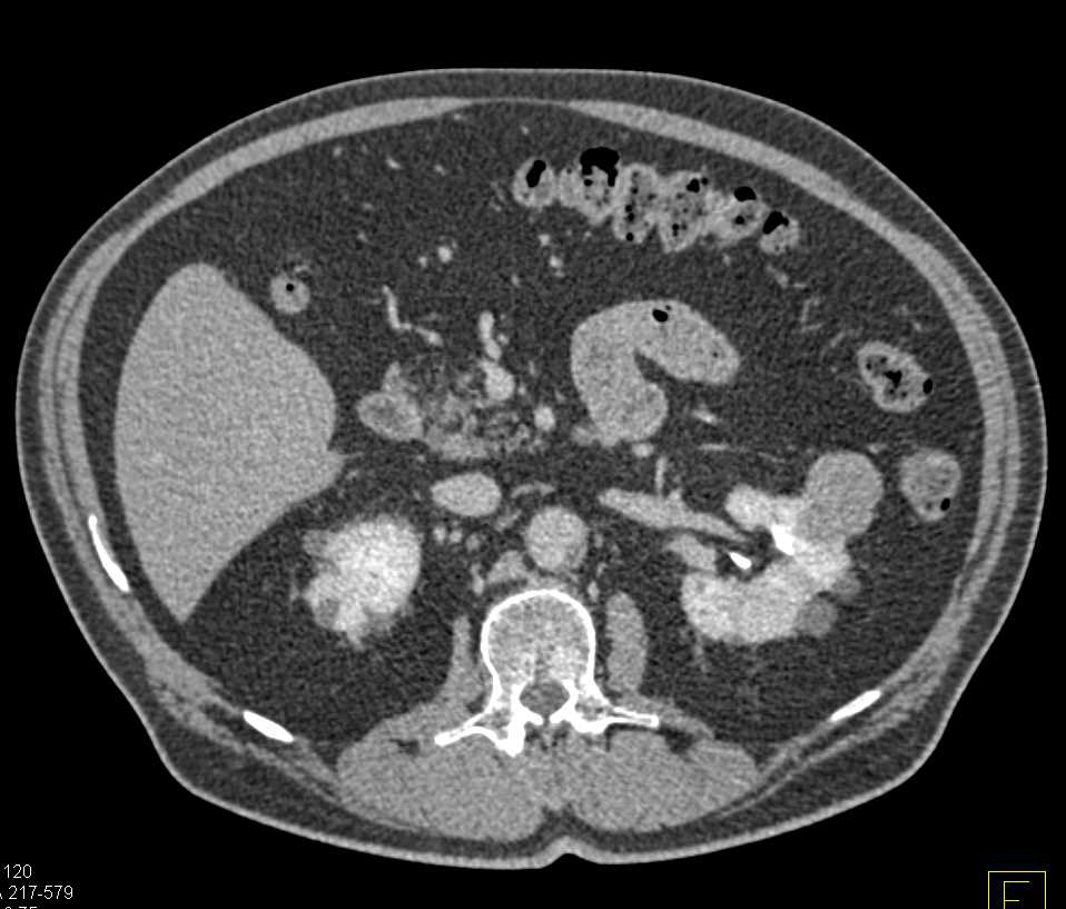 Left Adrenal Adenoma as an Incidental Finding - CTisus CT Scan