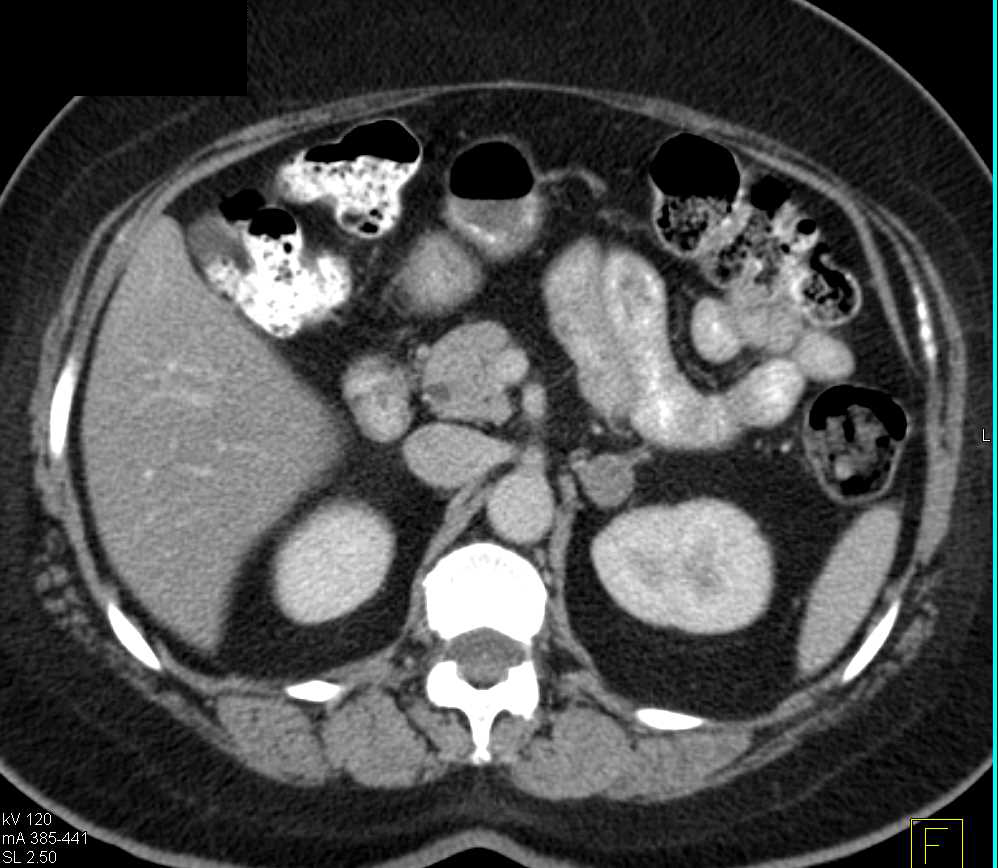 Left Adrenal Adenoma in Primary Hyperaldosteronism - CTisus CT Scan