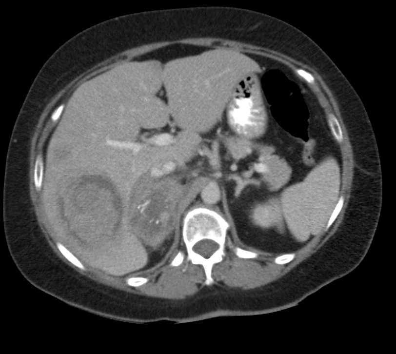 Sequence of two studies with Liver Metastases and Adrenal Metastases Growing - CTisus CT Scan