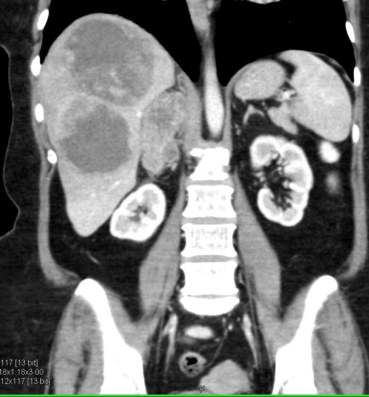 Necrotic Liver Metastases and Right Adrenal Metastases - CTisus CT Scan