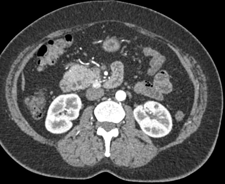 Carcinoma Head of the Pancreas - CTisus CT Scan