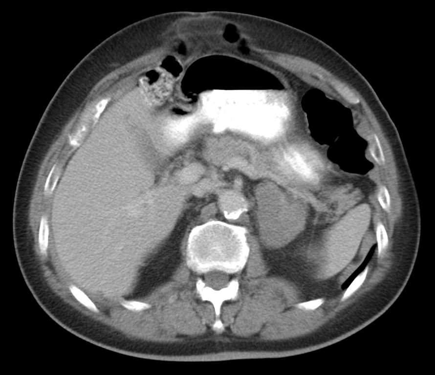 Left Adrenal Adenoma - CTisus CT Scan