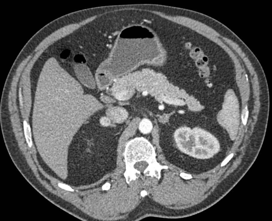 Metastatic Renal Cell Carcinoma to Right Adrenal Gland - CTisus CT Scan