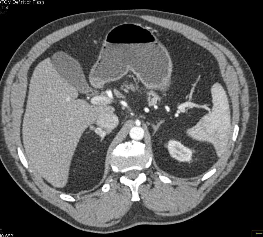 Metastatic Renal Cell Carcinoma to Right Adrenal Gland - CTisus CT Scan